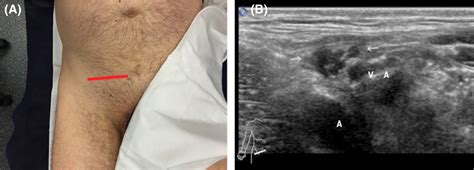 In adults, these may occur from progressive weakness of the abdominal wall, but this is rarely true in infants, children, or teenagers. . Male inguinal hernia real pictures